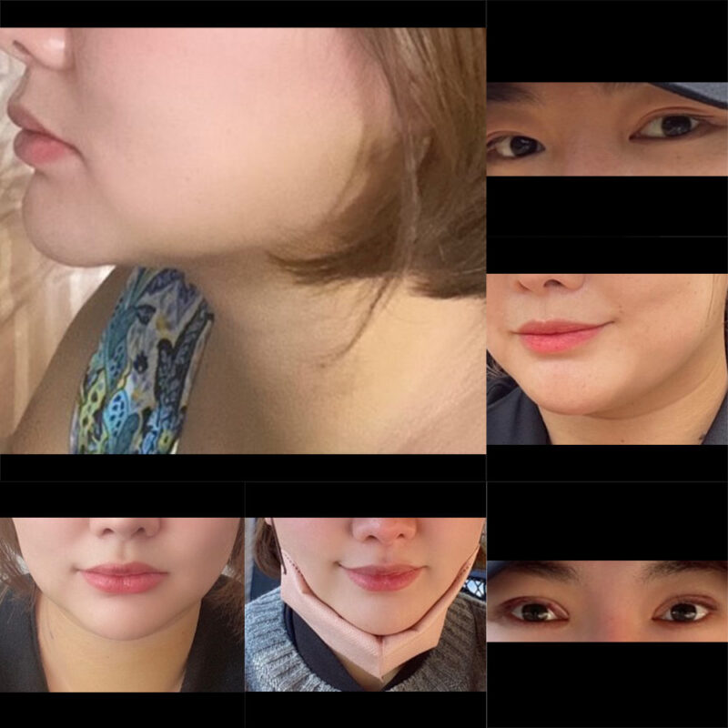 #2040미드업리프팅#눈(자연유착,비절개눈매교정)#필러(입술)