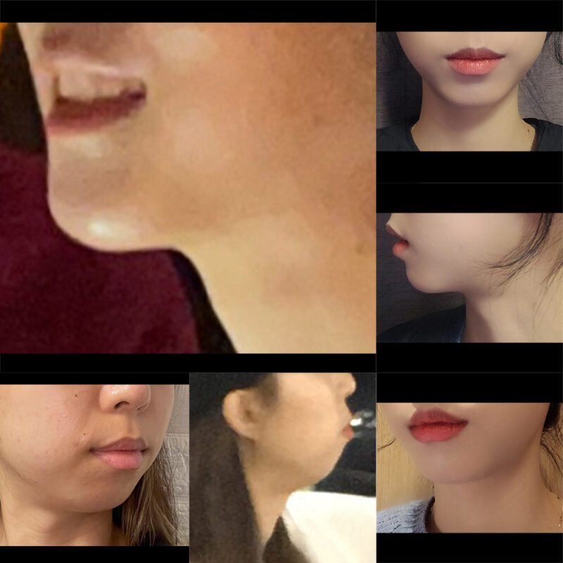 #턱끝전진
