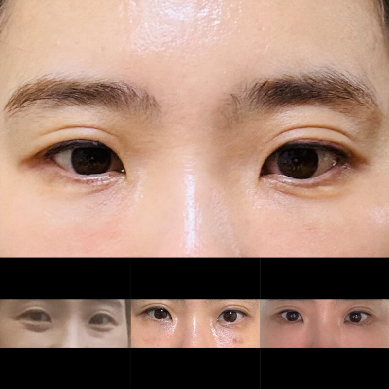 #눈밑지방재배치#지방이식(눈밑)