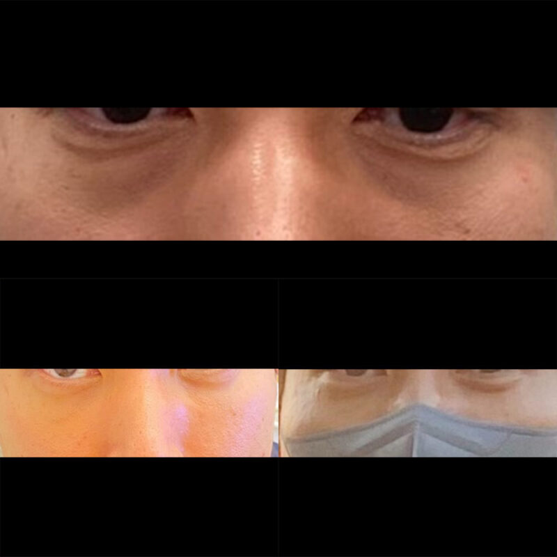 #눈밑지방재배치#지방이식(눈밑,팔자)#보톡스(이마)