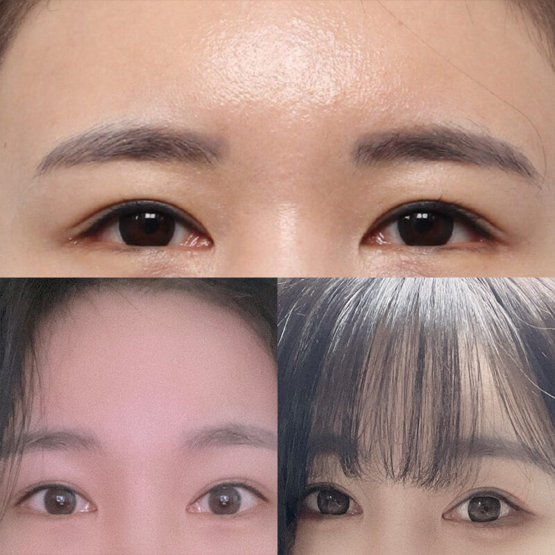 #2040이마거상#지방흡입(앞볼)#보톡스(이마,미간,자갈턱)#슈링크