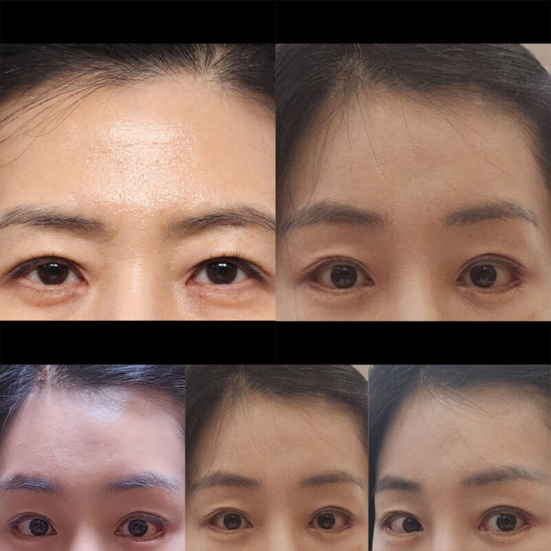 #5060이마거상#트임(뒤,밑)#보톡스(이마,미간,자갈턱)