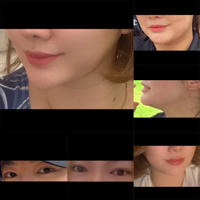 #2040미드업리프팅#눈(자연유착,비절개눈매교정)#필러(입술)