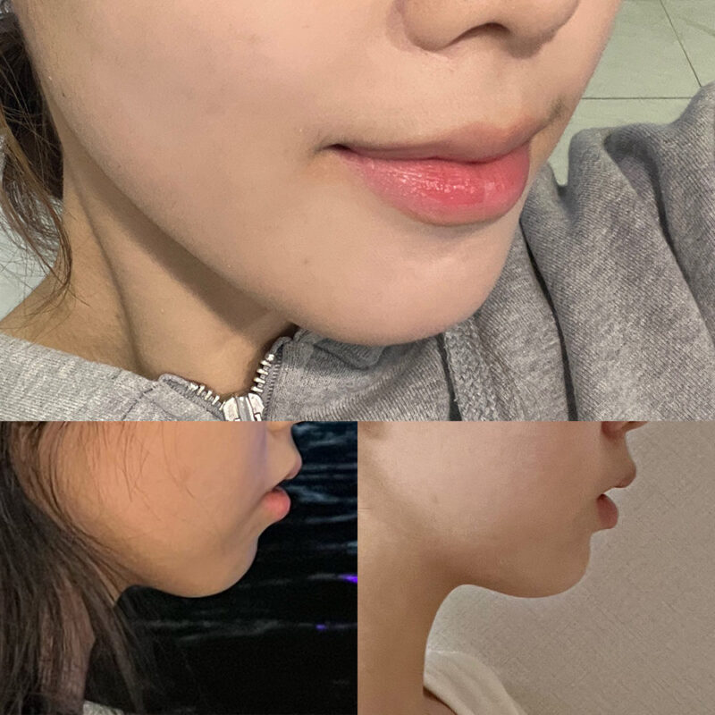 #턱끝전진