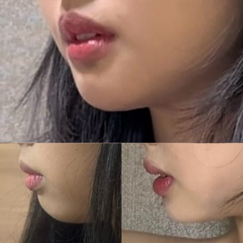 #턱끝전진#보톡스(사각턱,자갈턱)