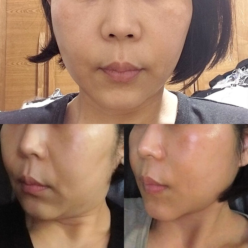#안면목거상#보톡스(자갈턱)