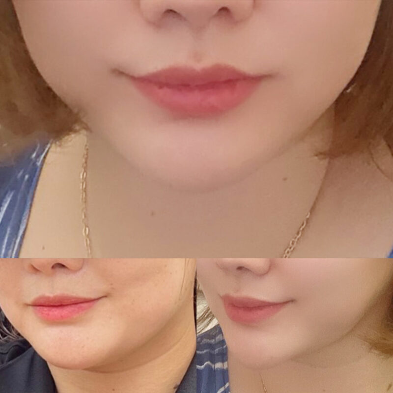 #2040미드업리프팅#자연유착#눈매교정(비절개)#필러(입술)
