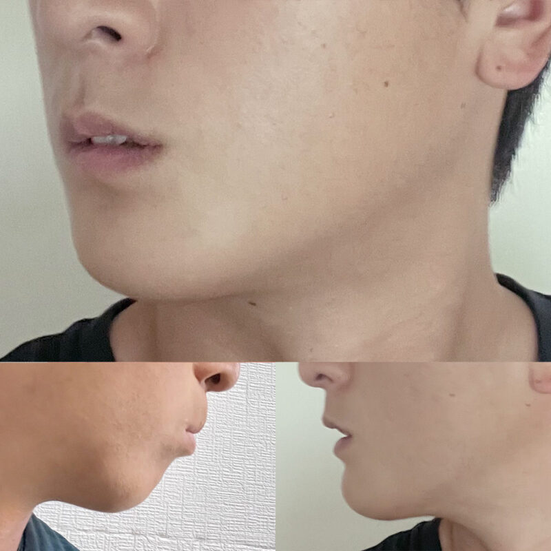 #턱끝전진