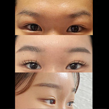 #눈썹뼈절제술 #2040이마거상