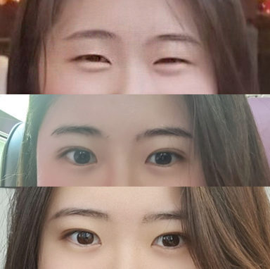 #자연유착 #눈매교정