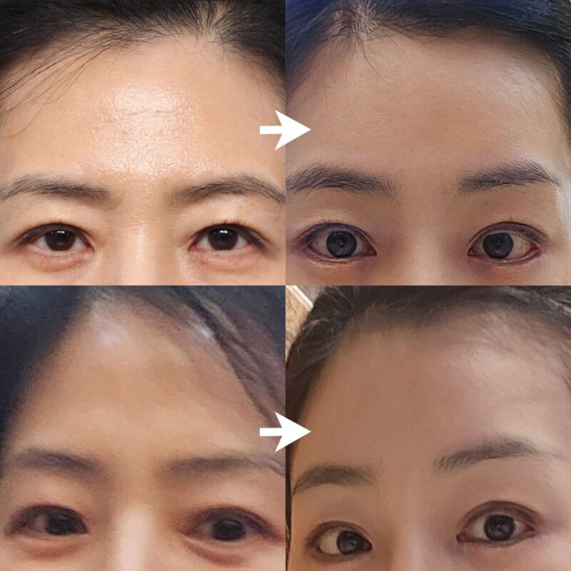 #5060이마거상 #뒤밑트임 #이마보톡스