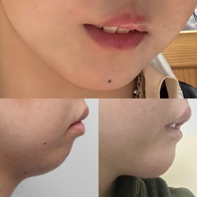 #턱끝전진술 #2040미드업리프팅