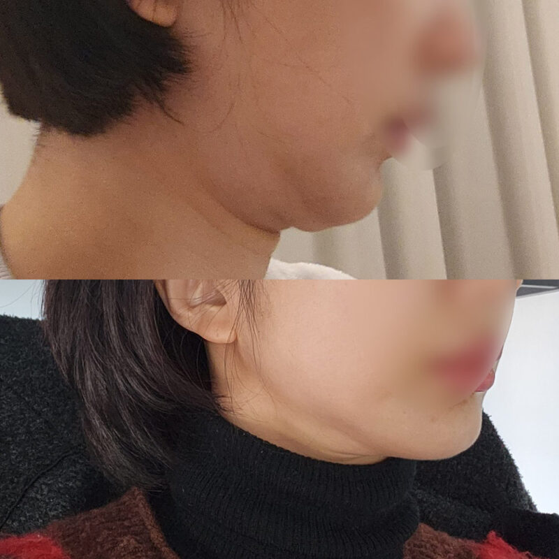 #2040미드업리프팅