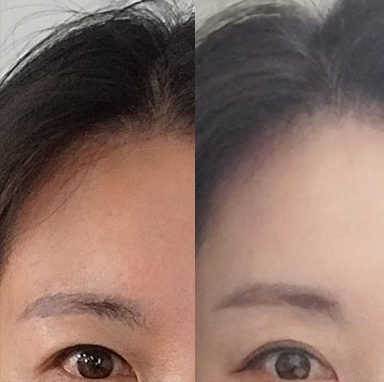 #5060이마거상 #눈밑지방이식