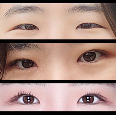 #비절개눈매교정 #앞트임