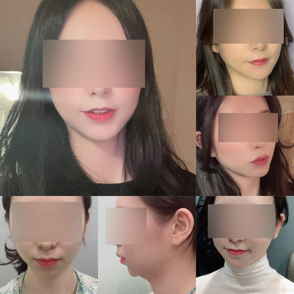 #턱끝전진술