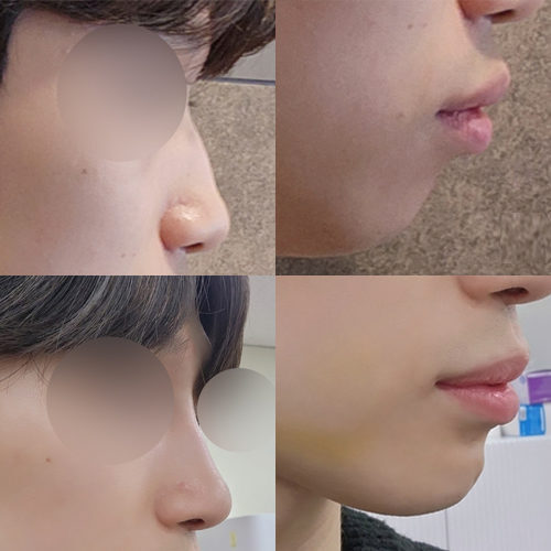 #턱끝전진술 #코성형