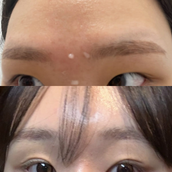 #2040이마거상 #눈썹뼈절삭 #매부리코교정