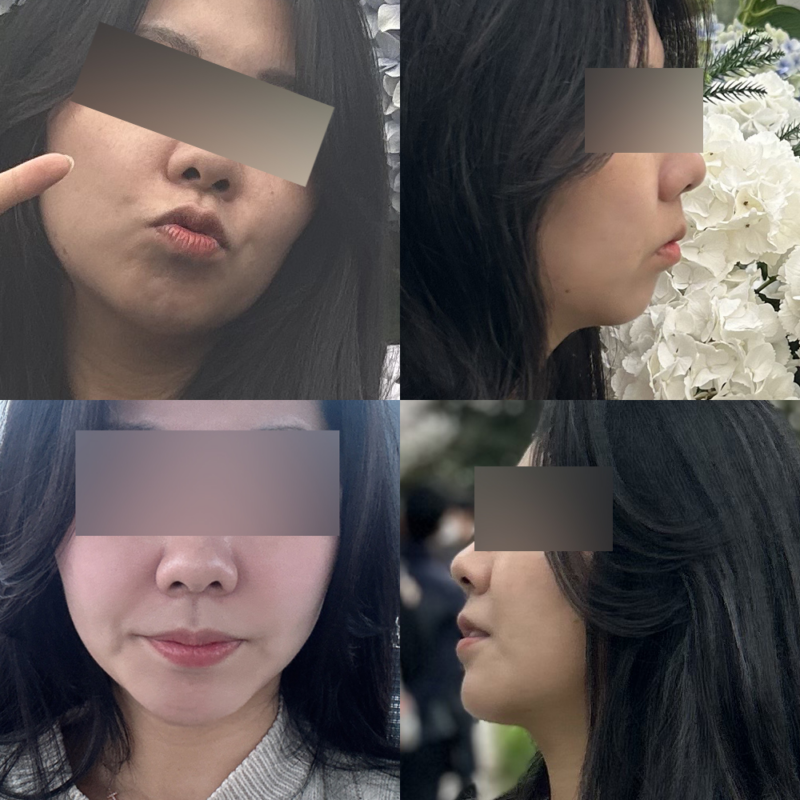#턱끝전진술
