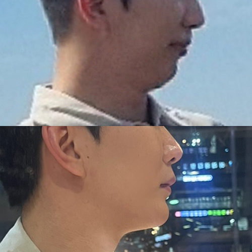 #턱끝전진술