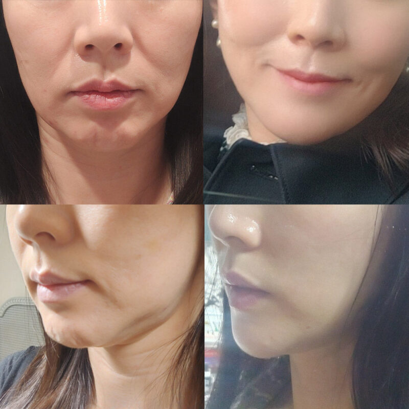 #안면목거상 #보톡스(자갈턱,침샘)