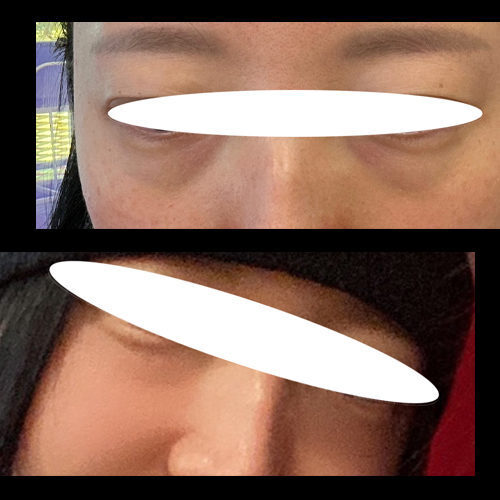 #눈밑지방재배치 #눈밑지방이식