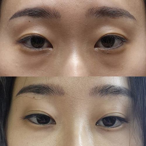 #눈밑지방재배치 #눈밑지방이식