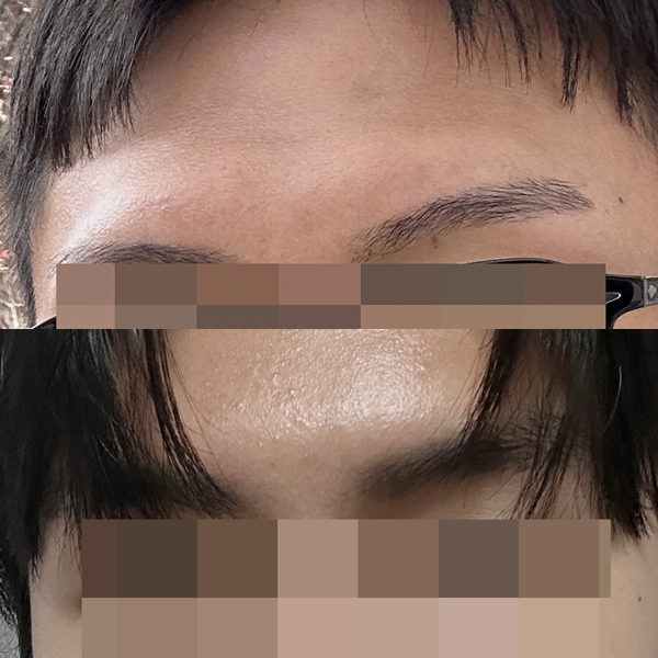 #눈썹뼈절삭