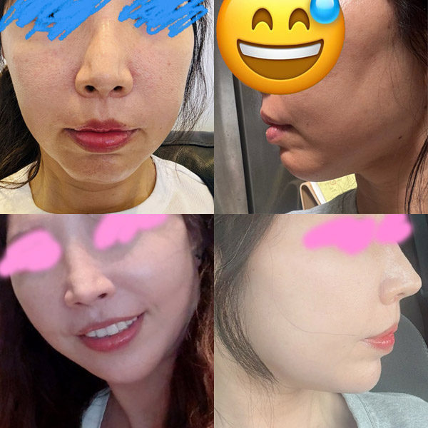 #5060미드업리프팅 #자갈턱보톡스