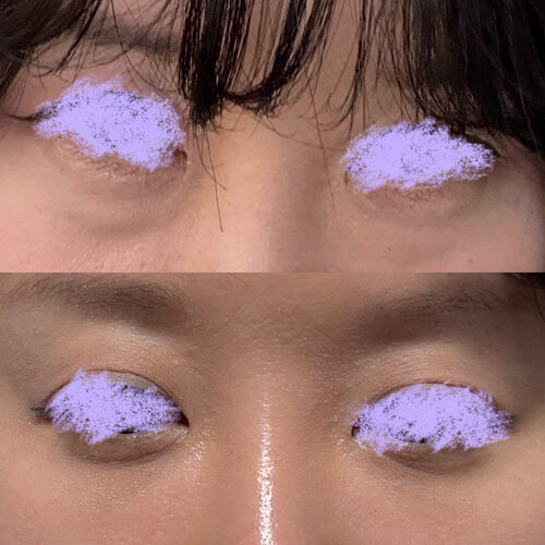 #눈밑지방재배치 #눈밑지방이식