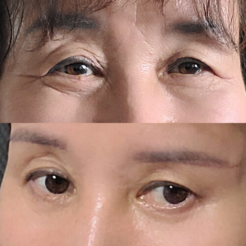 #하안검 #눈밑지방이식 #눈썹하거상