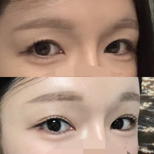 #5060이마거상(재수술) #눈썹뼈절삭
