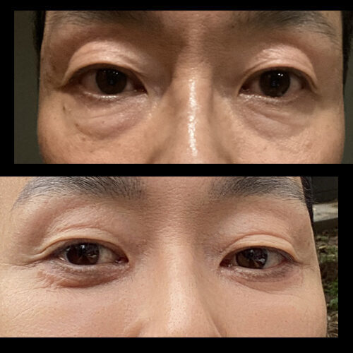 #하안검 #눈밑지방이식