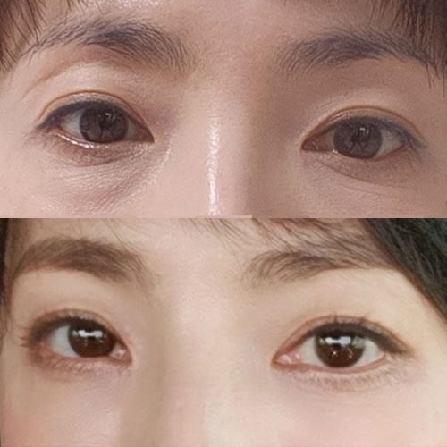 #하안검 #눈밑지방이식