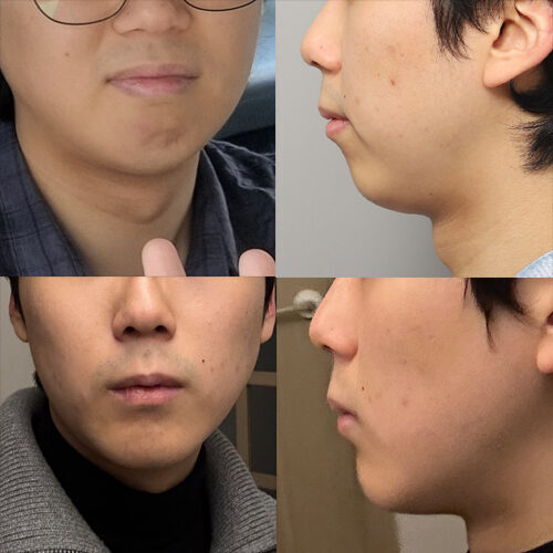 #턱끝전진술