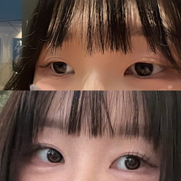 #2040이마거상 #눈썹뼈절삭