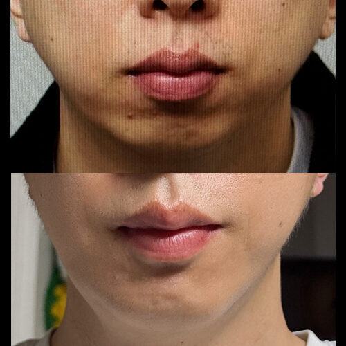 #턱끝전진술