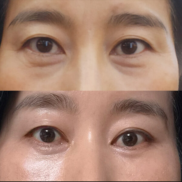 #하안검 #눈밑지방이식